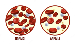 Ako doplniť železo - článok. Obrázok ktorý graficky znázorňuje rozdiel medzi krvou zdravou a krvou postihnutou anémiou. zelenyobchodik